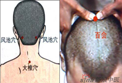 常見(jiàn)病艾灸時(shí)怎樣選穴？--大椎百會(huì )穴